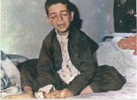  کودک مجروح شیمیایی سردشت