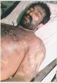 مجروح شیمیایی