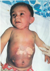 کودک مجروح شیمیایی سردشت