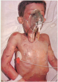 کودک مجروح شیمیایی سردشت