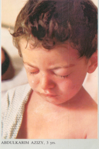 کودک مجروح شیمیایی سردشت