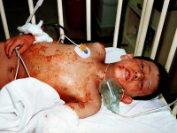 مجروح شیمیایی سردشت