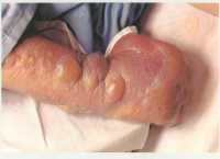 نوزاد مجروح شیمیایی